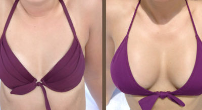 mersin gögüs büyütme mersin 6